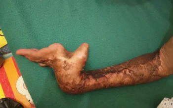 Kecelakaan Kerja Adzan Agustian di Kampar