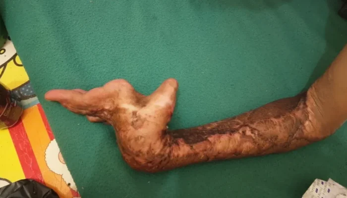 Kecelakaan Kerja di Kampar, Adzan Agustian Alami Luka Bakar dan Perjuangkan Haknya